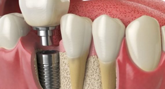 Dental Implant Durability