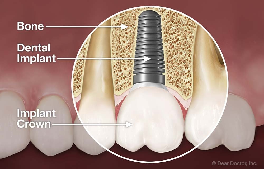 Dental Implant Preserve Bone Structure